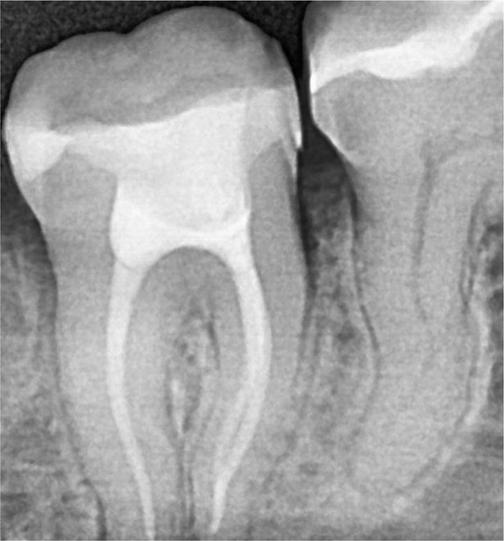 Лечение пульпита