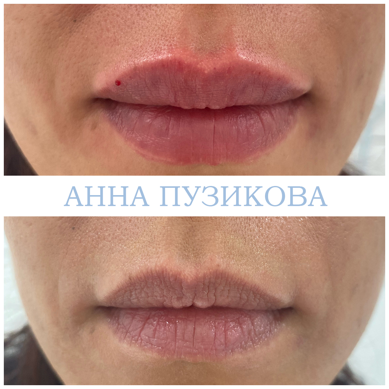 Естественное увеличение губ филлером без избыточного объёма — фото до и после процедуры у косметолога Анны Пузиковой в клинике Прадус (СПб).