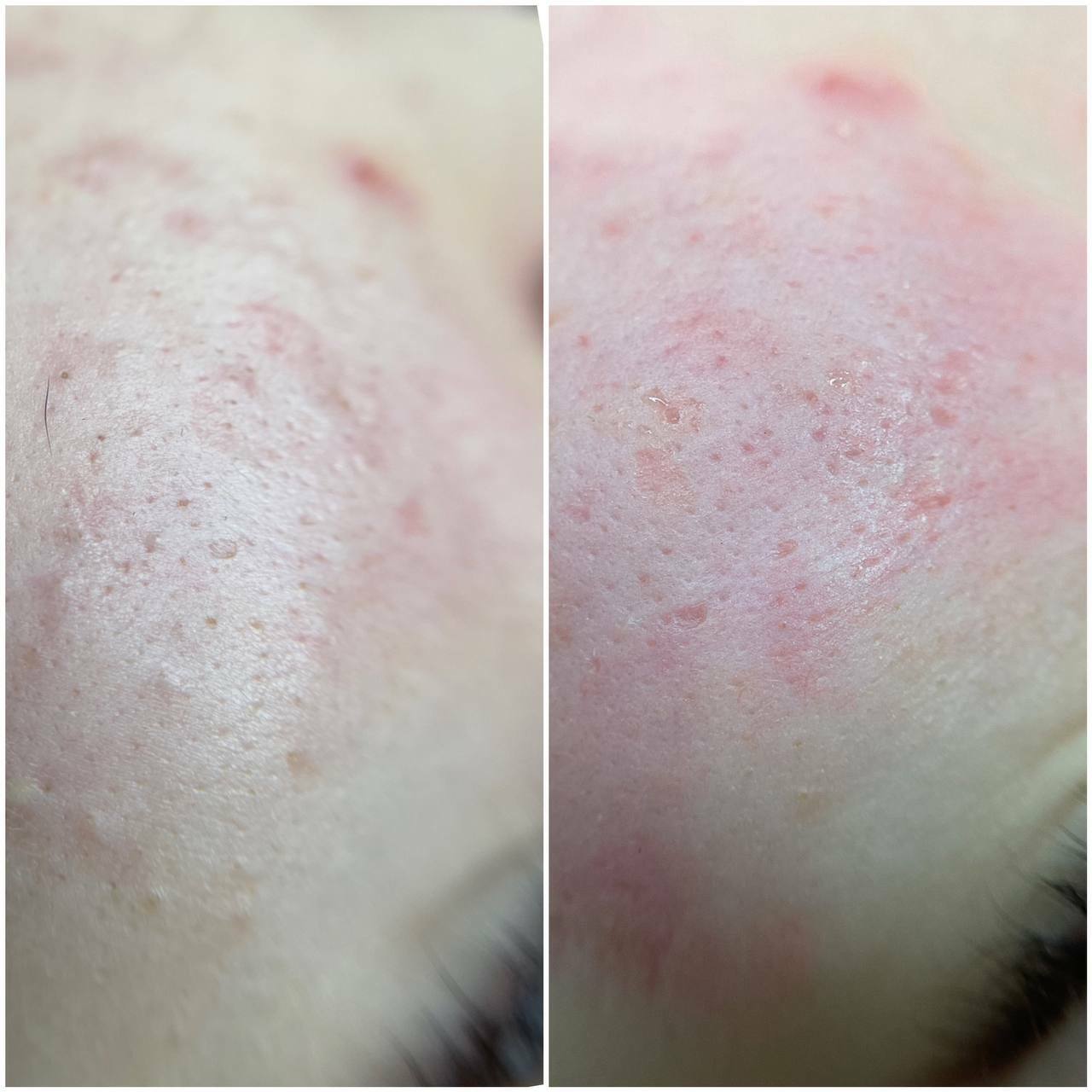 ДО/ПОСЛЕ ЭСТЕТИЧЕСКИХ ПРОЦЕДУР