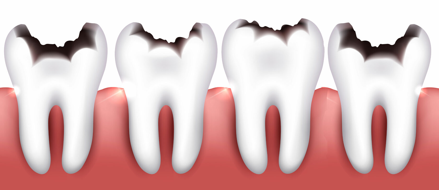 Трещина или перелом зуба