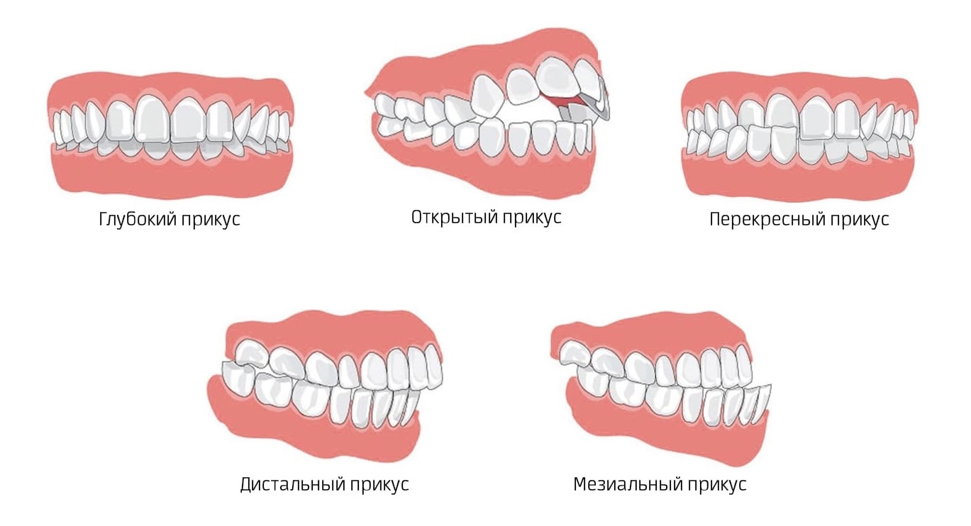 Правильный прикус у человека схема как определить фото