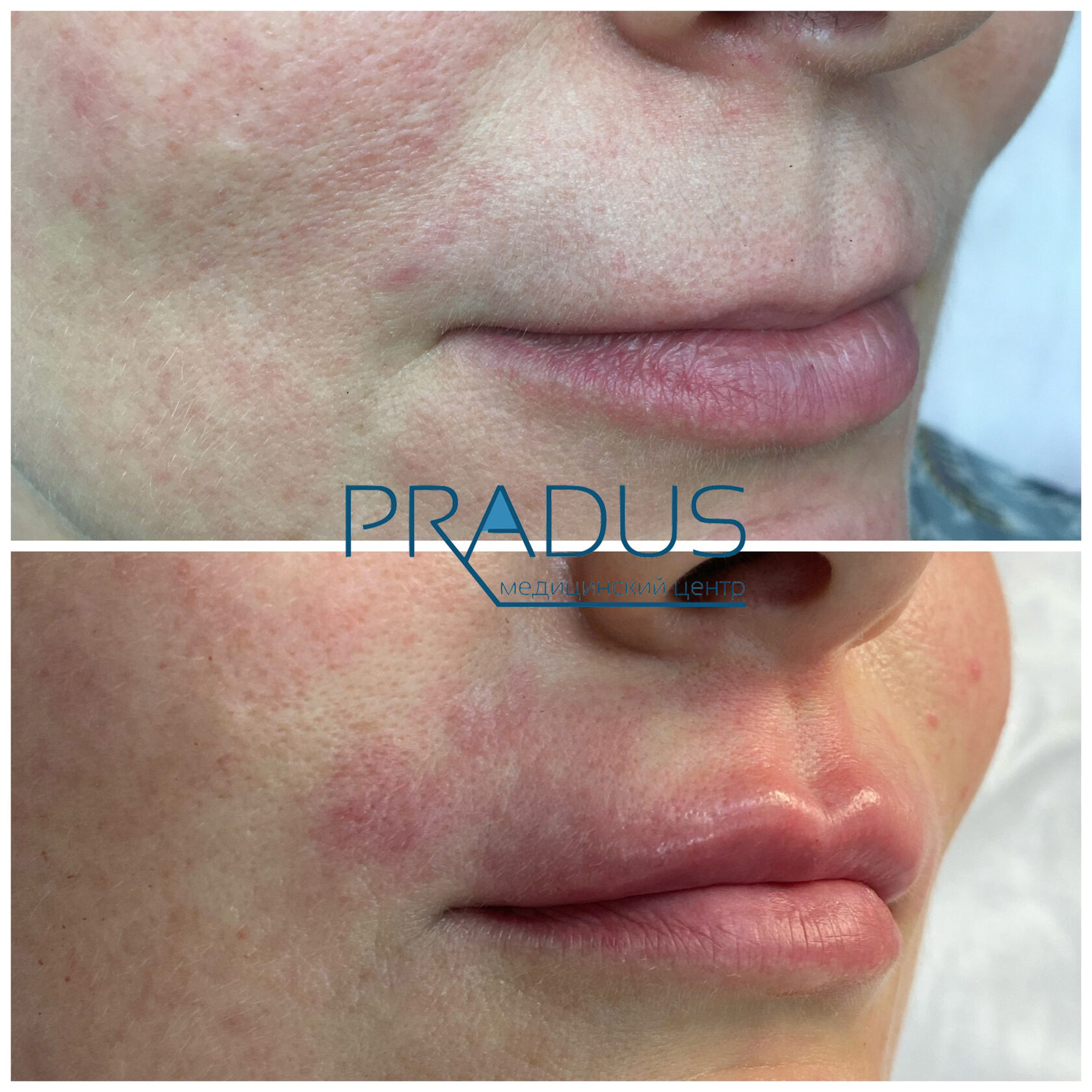 До и после контурной пластики губ. Увеличение объёма без утяжеления. PradusCOSMO, Васильевский остров