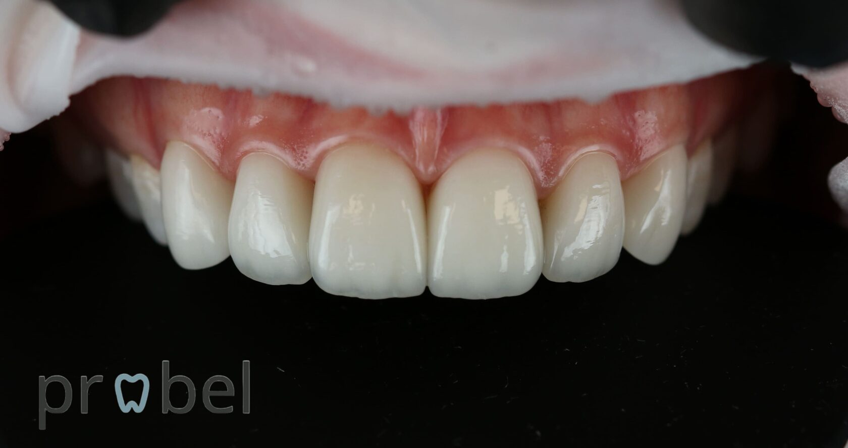 Установка керамических виниров emax пациенту клиники Пробел в Москве