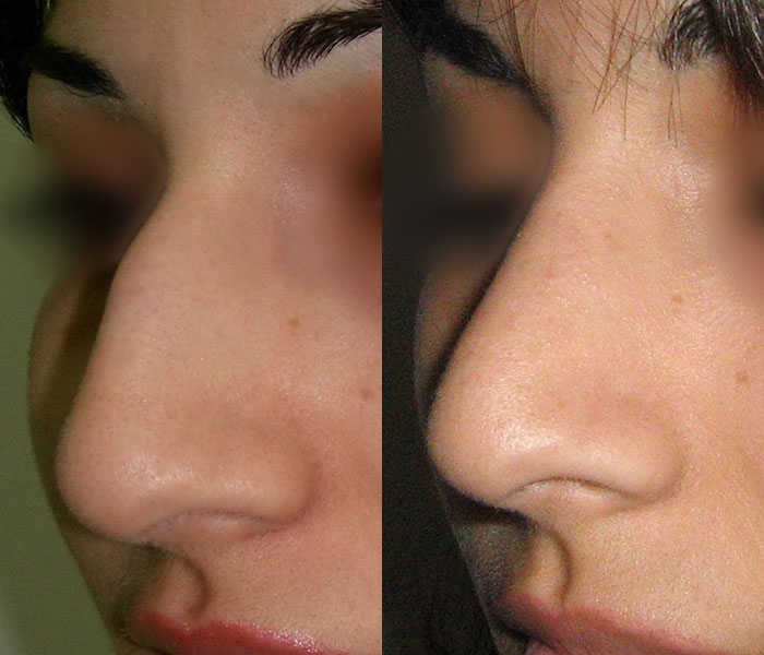 Горбинка на носу без операции. Ринопластика горбинки носа. Нос с горбинкой 3/4. Нос смгорбинкой ринопластика.