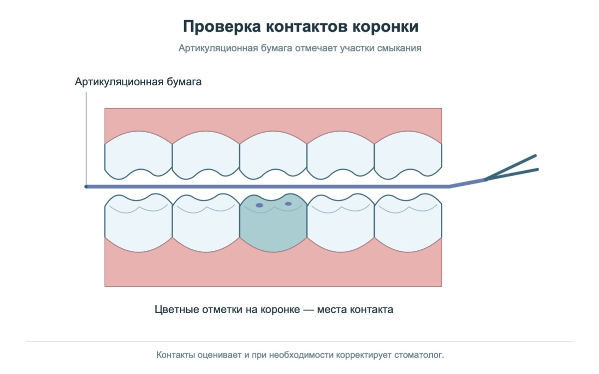 Проверка контактов коронки при смыкании зубов на модели