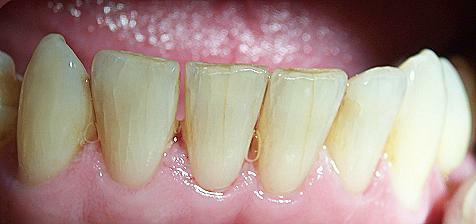 Трещина корня зуба: симптомы и методы лечения