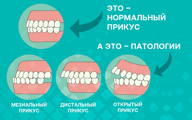 Прикус у ребенка: когда бить тревогу Советы ортодонта