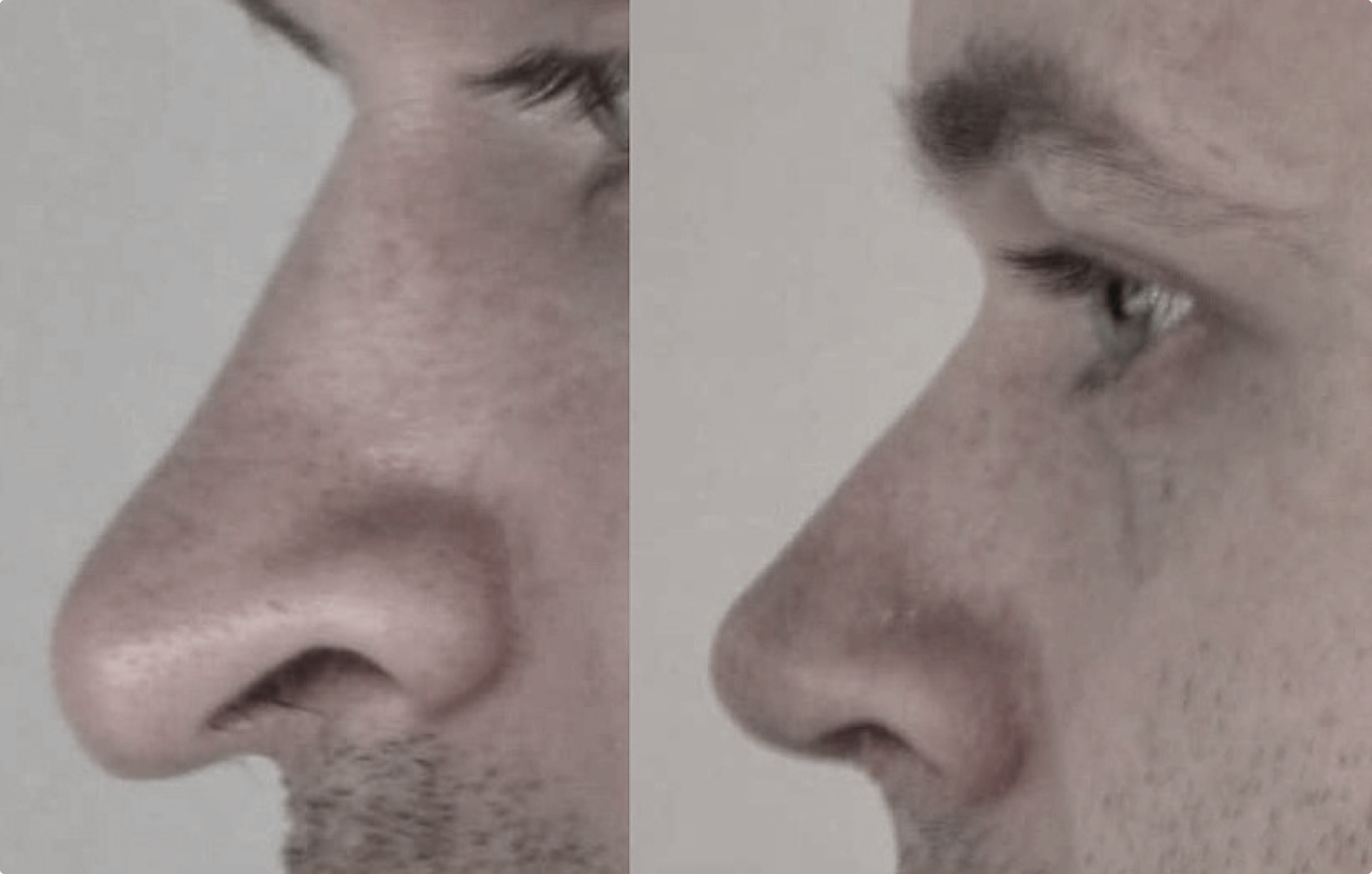 Ультразвуковая ринопластика носа. Самарцев ринопластика.