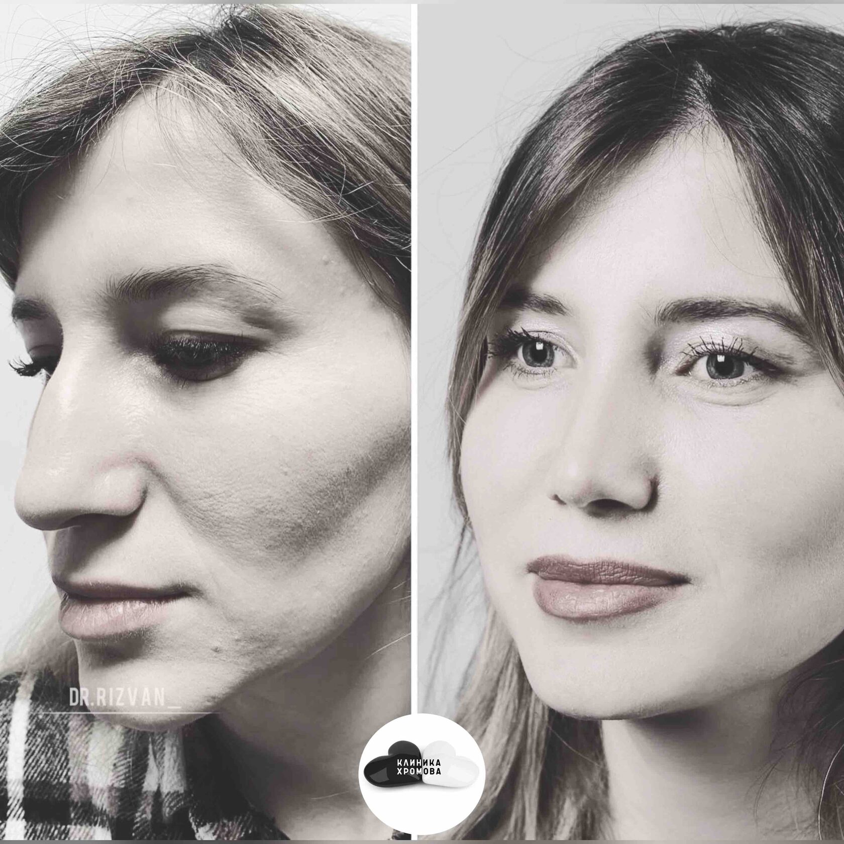 Ринопластика клиники. Пластическая операция на нос. Пластическая хирургия полное переделка лица.