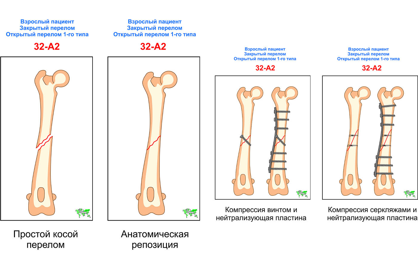 Перелом 2 костей. Классификация переломов AOVET. Остеосинтез классификация травматология. Классификация переломов длинных трубчатых костей ao/Asif. Классификация переломов Ветеринария.