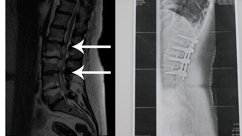 Стеноз позвоночного канала что это такое и как лечить симптомы фото