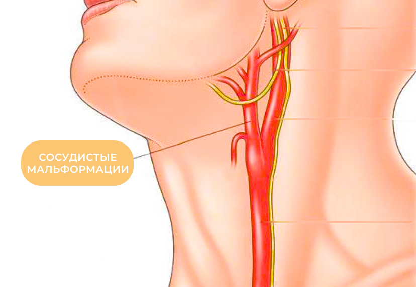 Заболевание брахиоцефальных артерий. Брахиоцефальные артерии атеросклероз. Непрямолинейность хода позвоночной артерии. Наружная сонная артерия анатомия ветви. Позвоночная артерия анатомия кт.