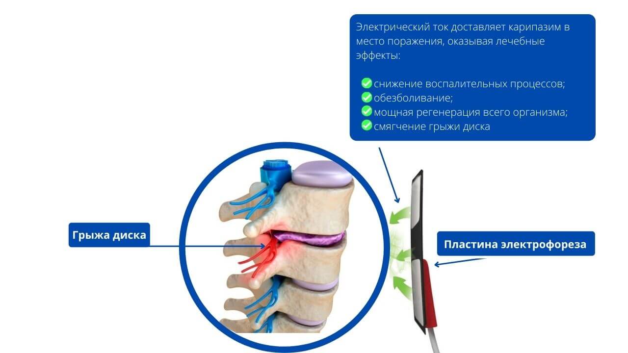 Карипазим Для Электрофореза При Грыже Позвоночника Отзывы 2024