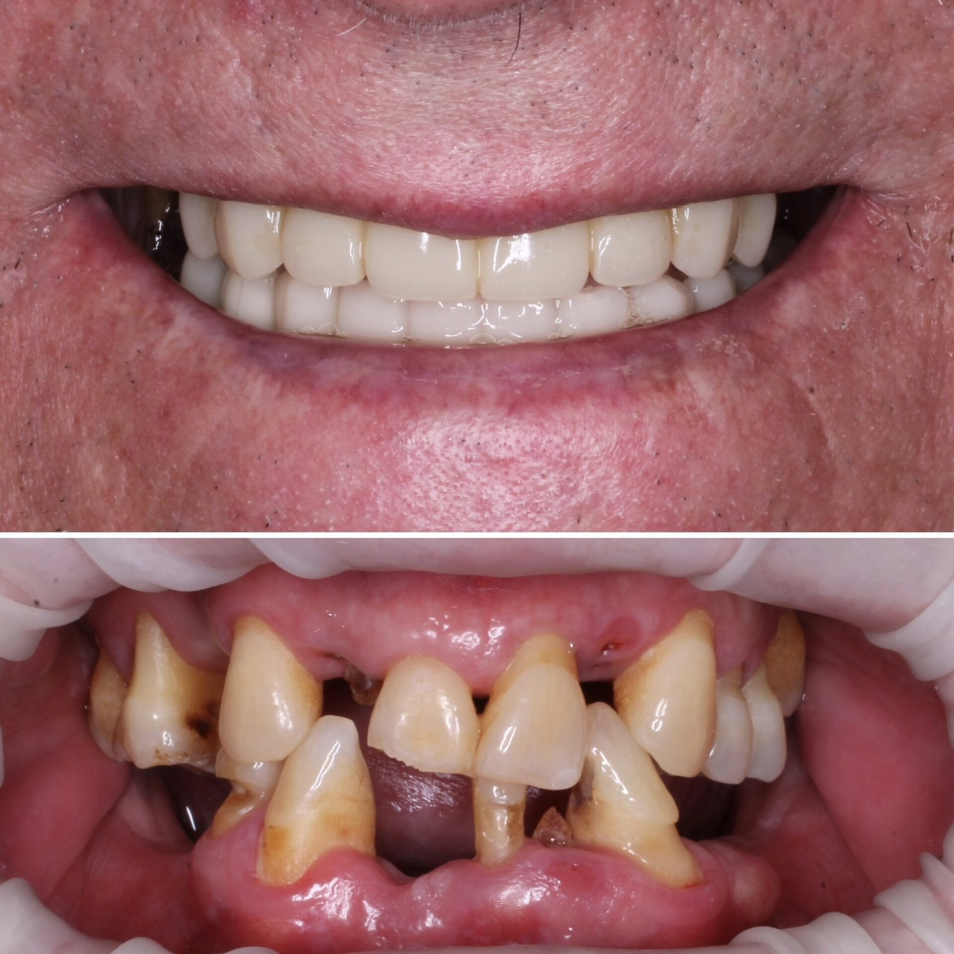 имплантация зубов чебоксары,имплантация зубов йошкар-ола,тотальная реабилитация на 6 имплантатах,протез несъемный в чебоксарах