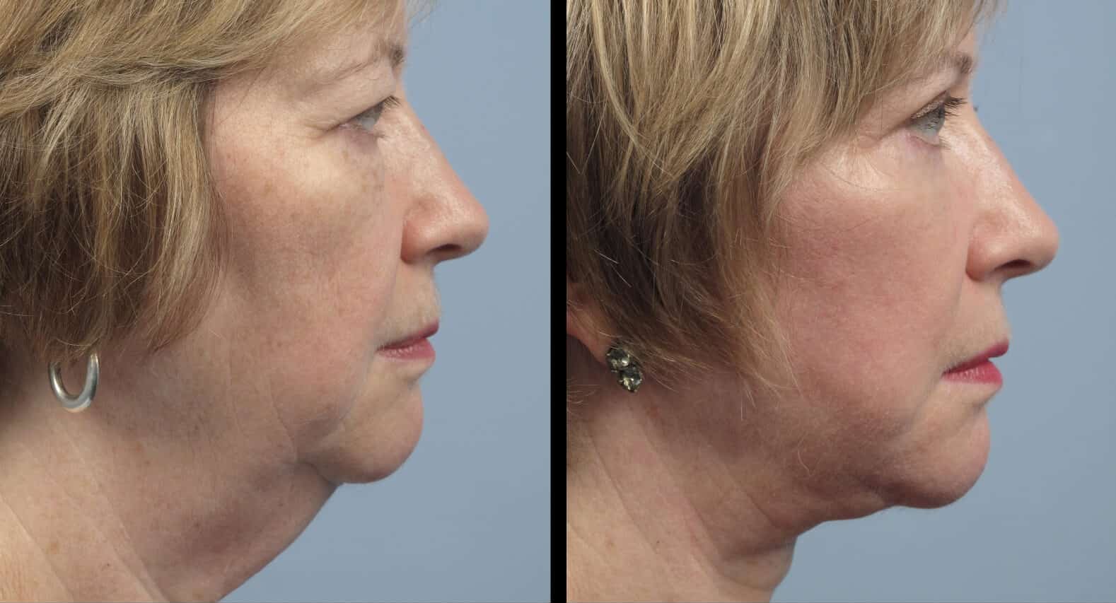 Удаление брылей на лице операция фото до и после