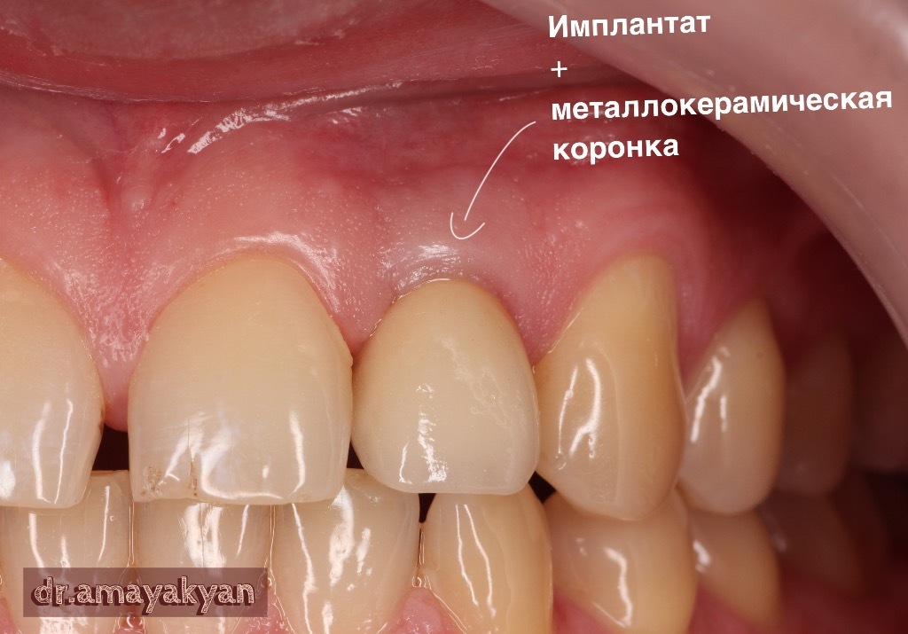 Прыщ на десне - полезные статьи стоматологической сферы в блоге «Гелиоса».