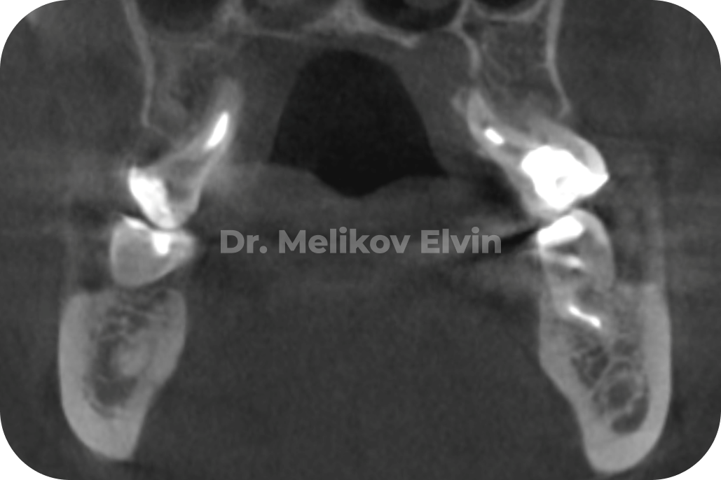 Фотографии прикуса до и после операции по расширению верхней челюсти.