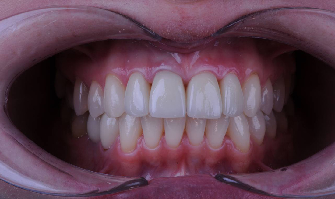 Эстетическая реабилитация зоны улыбки