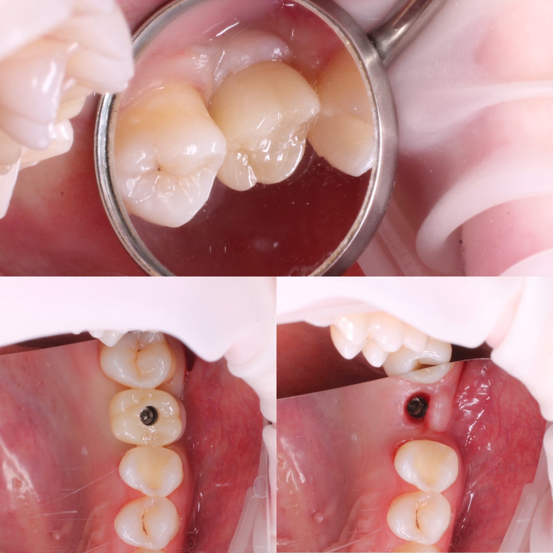 имплантация зубов в Чебоксарах,Йошкар-оле,имплантация,акция на имплантацию зуба,рассрочка на имплантацию