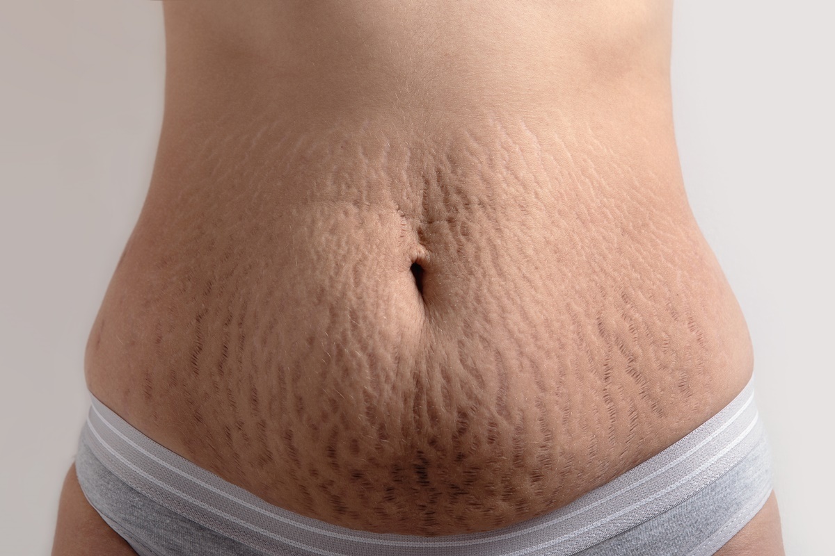 растяжки на животе, растяжки после беременности