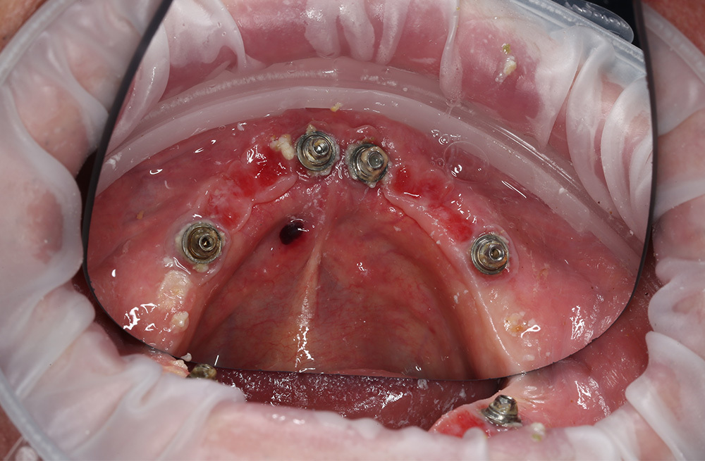 Комплексная гигиена полости рта для пациента со съемными конструкциями