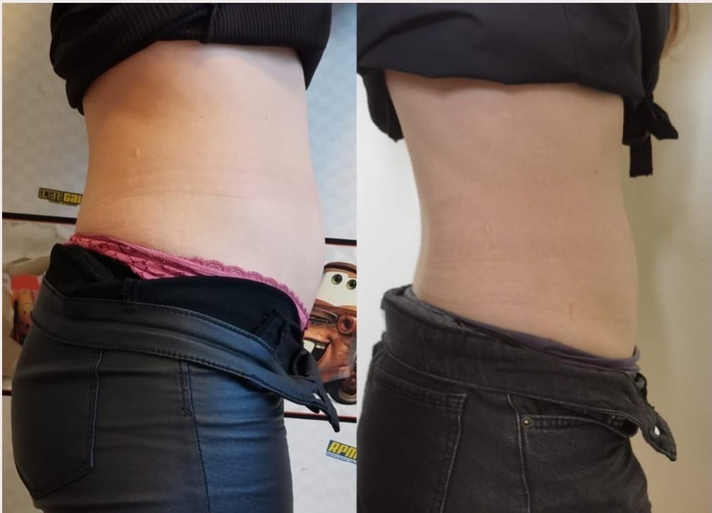 до/после живот после ручной липокоррекции