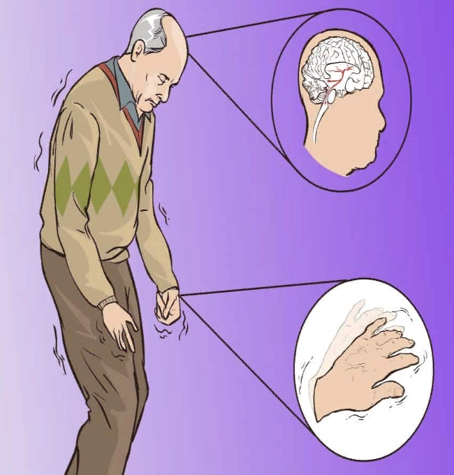Болезнь паркинсона симптомы стадии болезни