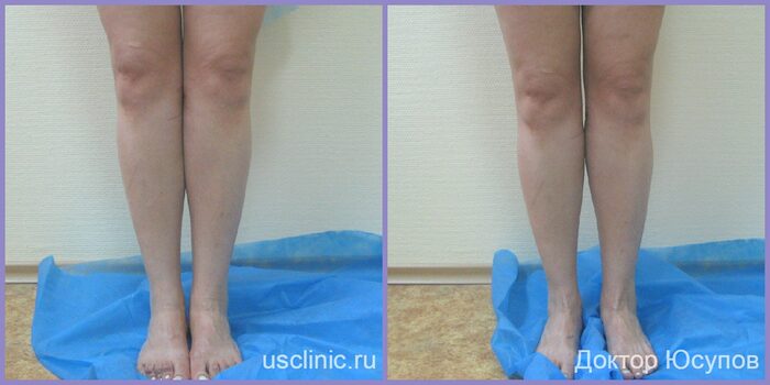 Круропластика - фото до/после