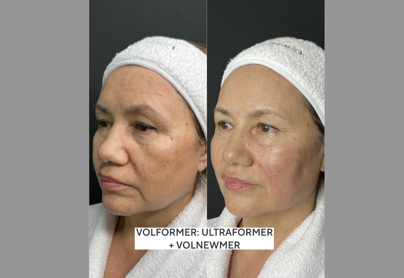 Волформер ( Волньюмер и Ультраформер ) 