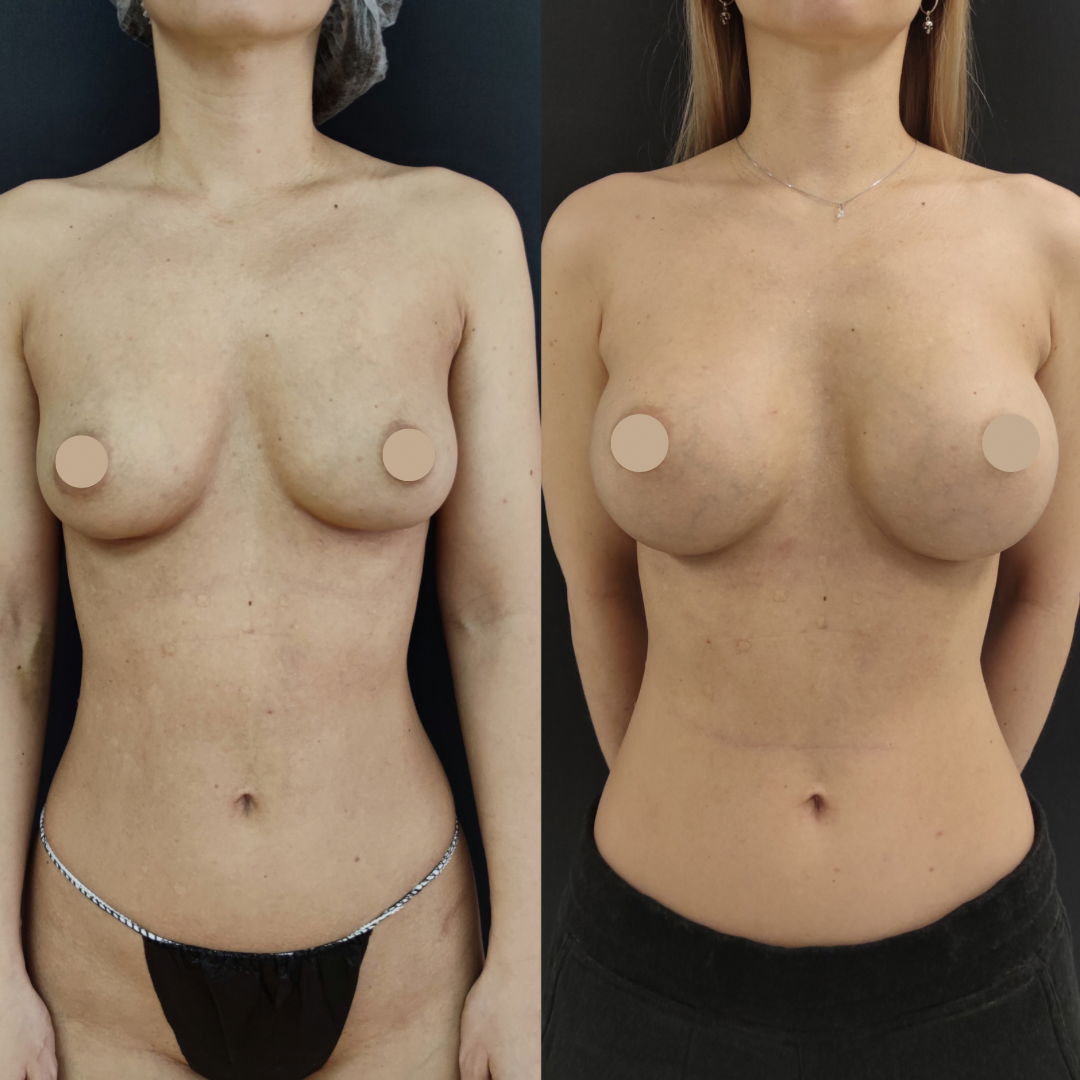 импланты для 3 размера груди фото 39