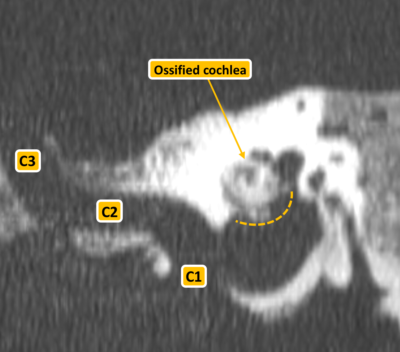 Инфралабиринтная холестеатома, улитка, КТ височных костей