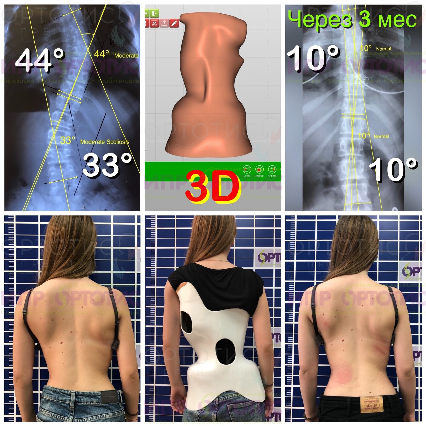 Корсет для сколиоза 3 степени