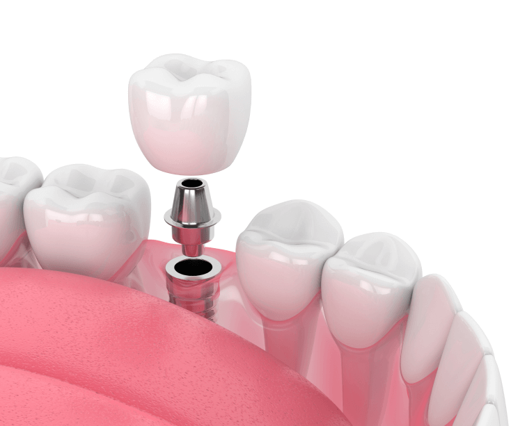 Имплант Dentium SuperLine