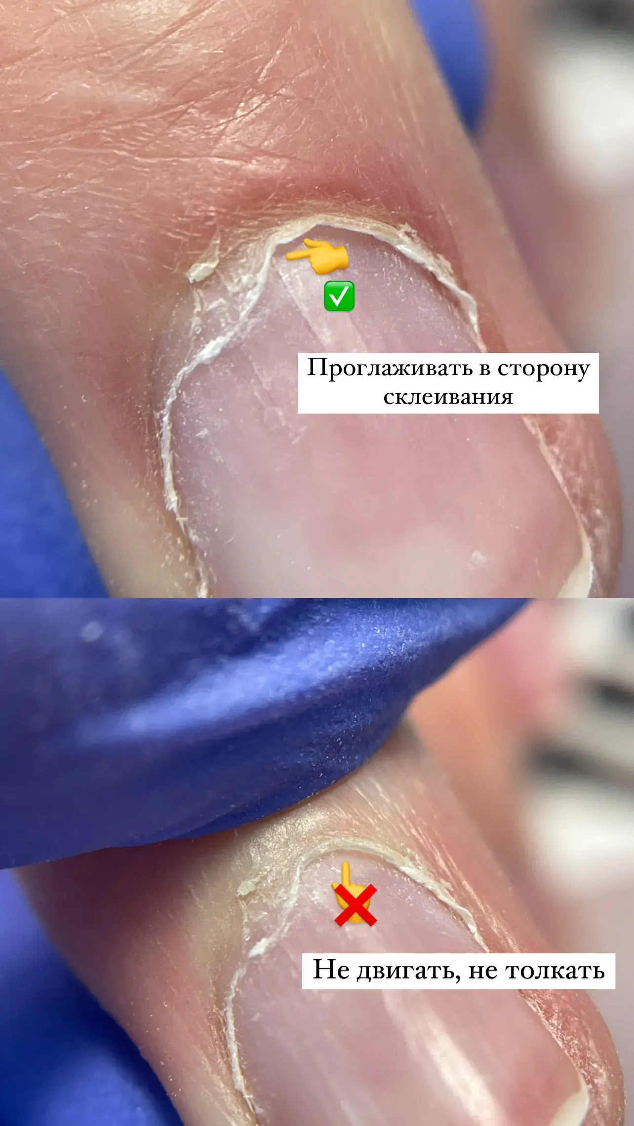 Налипшая кутикула на ногте перед обработкой. Работа пушером при открытии кармана с налипшей кутикулой. Обработка налипшей кутикулы фрезой «пламя» во время маникюра. курс комиби маникюра бесплатно