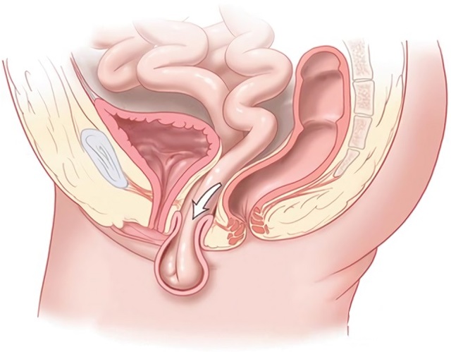 Памятка для пациенток после влагалищных операций.