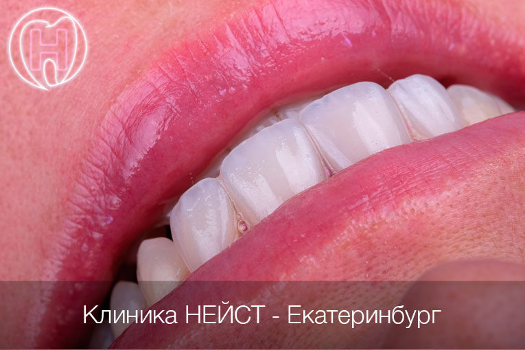 Авторские композитные виниры c прозрачным краем в Екатеринбурге, цвет Блич 4