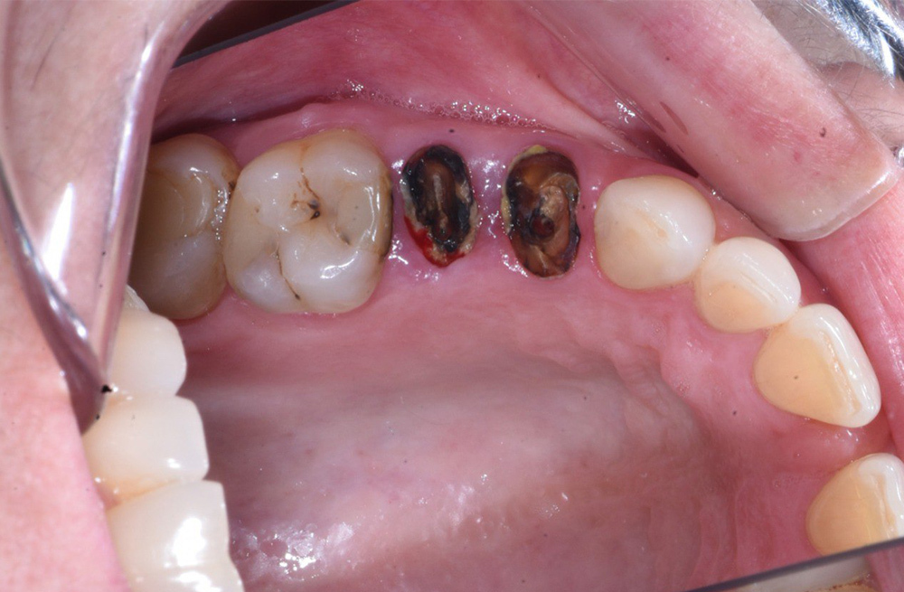 Восстановление жевательной функции с помощью одномоментной имплантации