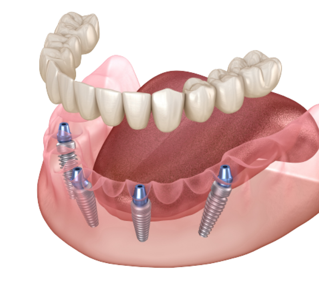 Несъемный зубной протез на 4 имплантах