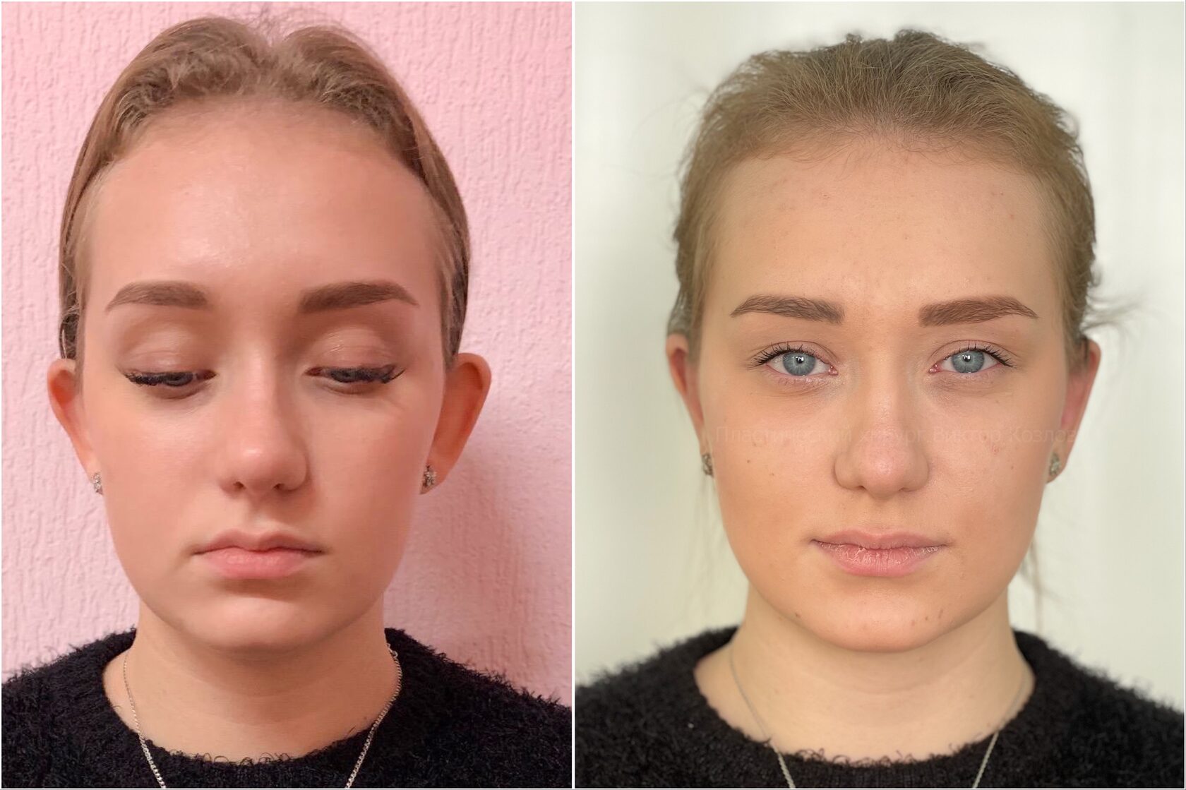 отопластика фото до и после операции