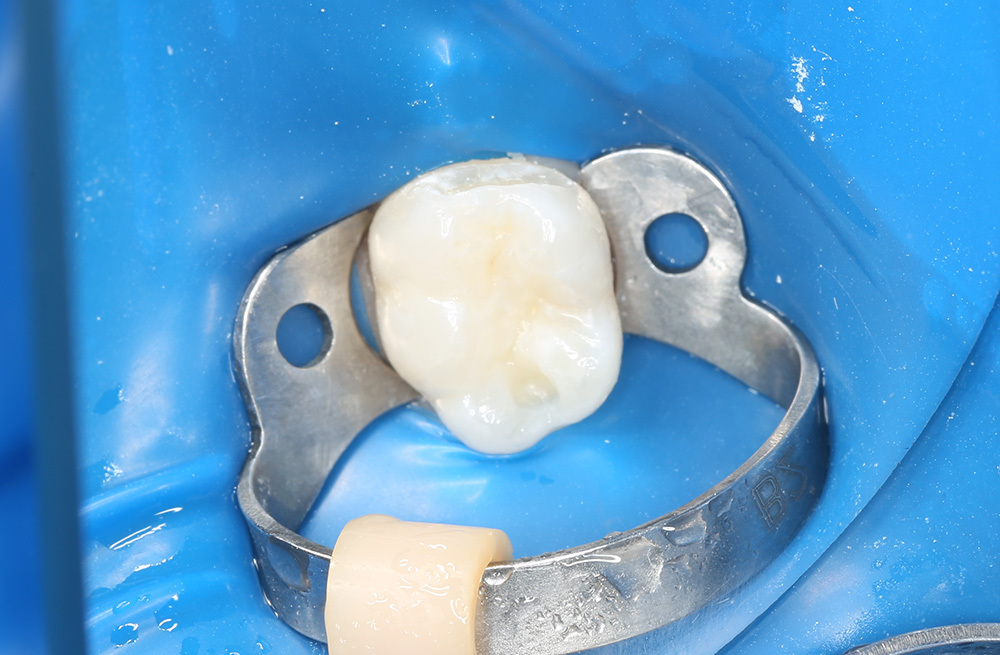 Восстановление молочного зуба у ребёнка после глубинного кариеса дентина