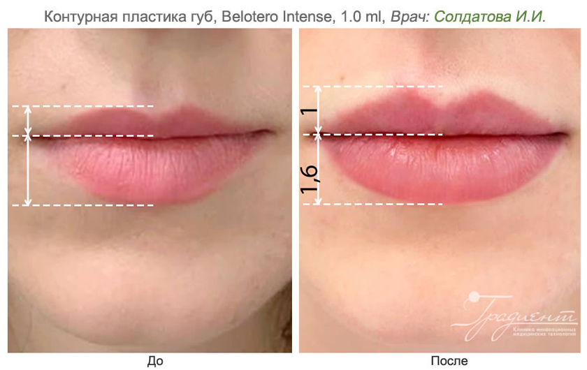 Контурная пластика воронеж