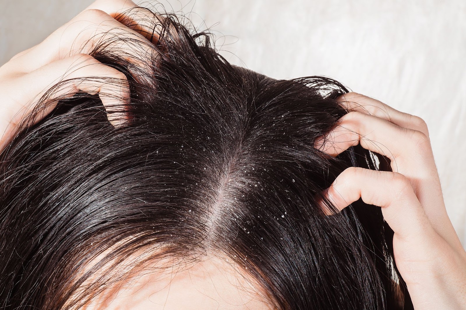 Выпадение волос при себорее