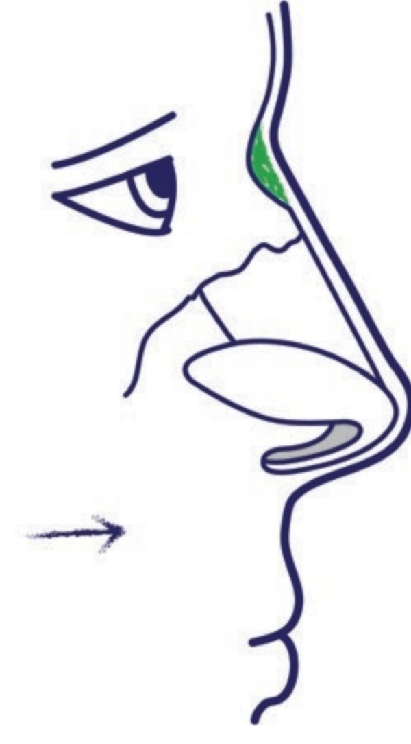 Сделать ринопластику| Красноярск | Новосибирск