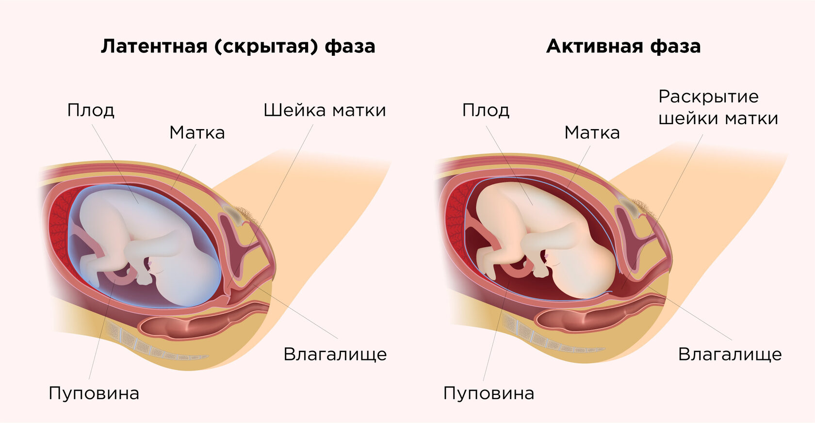 Почему нет раскрытия шейки матки при родах у первородящих