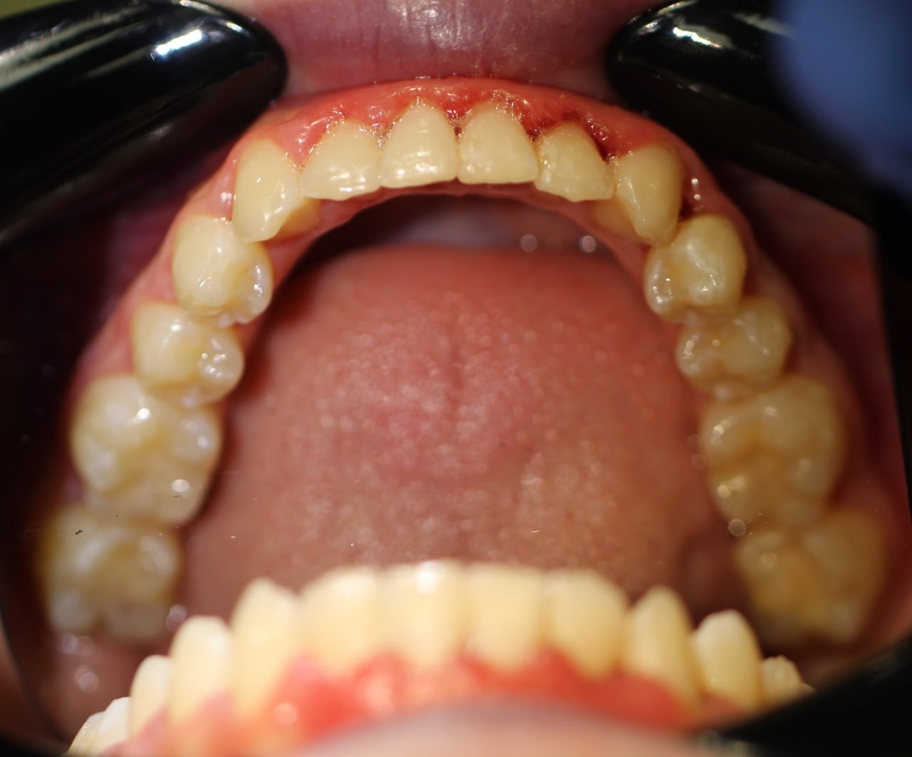 Нижний зубной ряд после лечения на элайнерах Star Smile