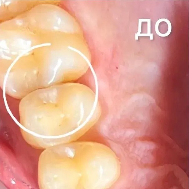 Установлено 2 имплантата и 2 коронки из диоксид циркония. Врач Фаттахов М.Д.