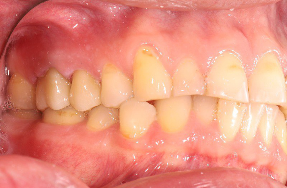 Устранение контактного дискомфорта между зубами с помощью протезирования коронками