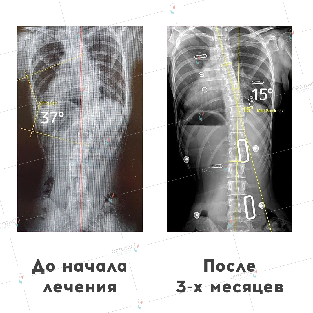 Лечение сколиоза за границей