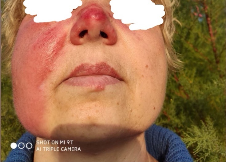 Практика лечения рожистого воспаления вытяжками Солодовниковой