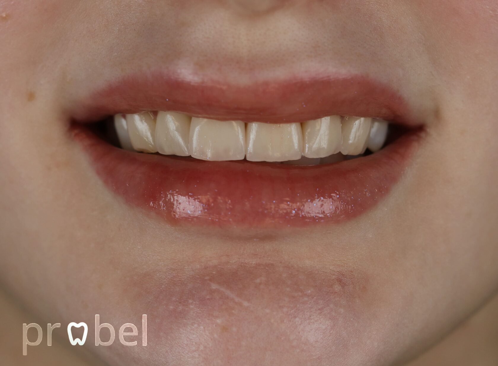 Выраженная стираемость зубов и десневая улыбка до лечения в Probel Clinic